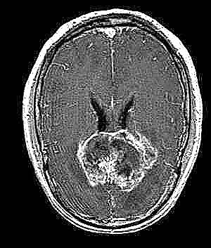 Brain MRI sample