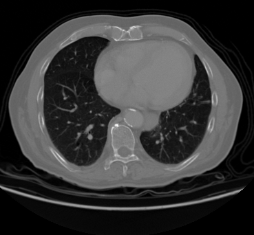 Chest CT sample